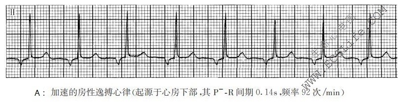 逆行P波、正相逆行P波