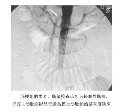 内脏动脉综合征（肠系膜上动脉供血障碍）