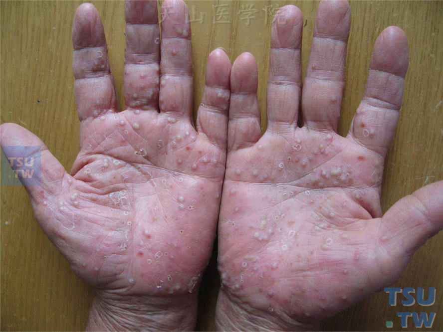掌跖脓疱病（palmplantar pustulosis）的症状表现