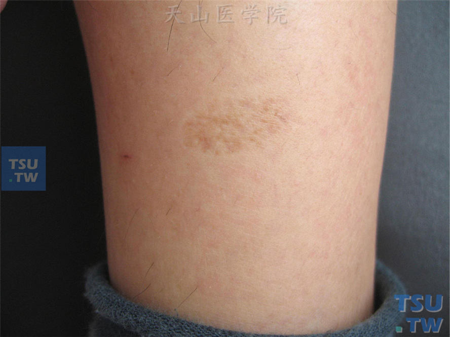 进行性特发性皮肤萎缩的症状表现