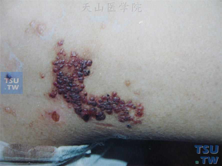 良性肿瘤：血管角皮瘤（angiokeratoma）症状表现