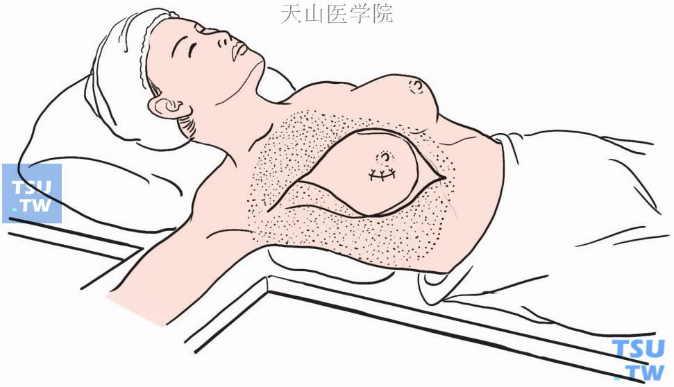 乳腺癌改良根治性切除术