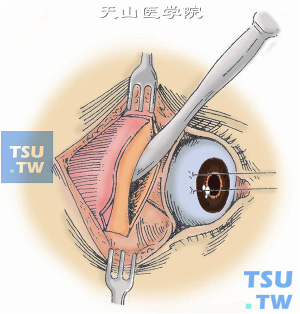 眶外侧进路眼眶肿瘤摘除术