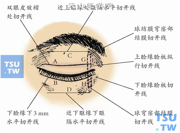 上下睑与结膜囊联合切口眼眶肿瘤摘除术