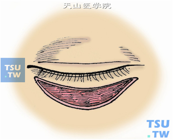 眼睑皮片游离移植术
